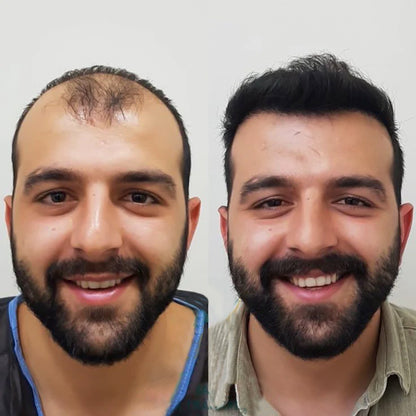 FEG Plus 👉( Men & women ) Hair Growth Spray ✅100% Original