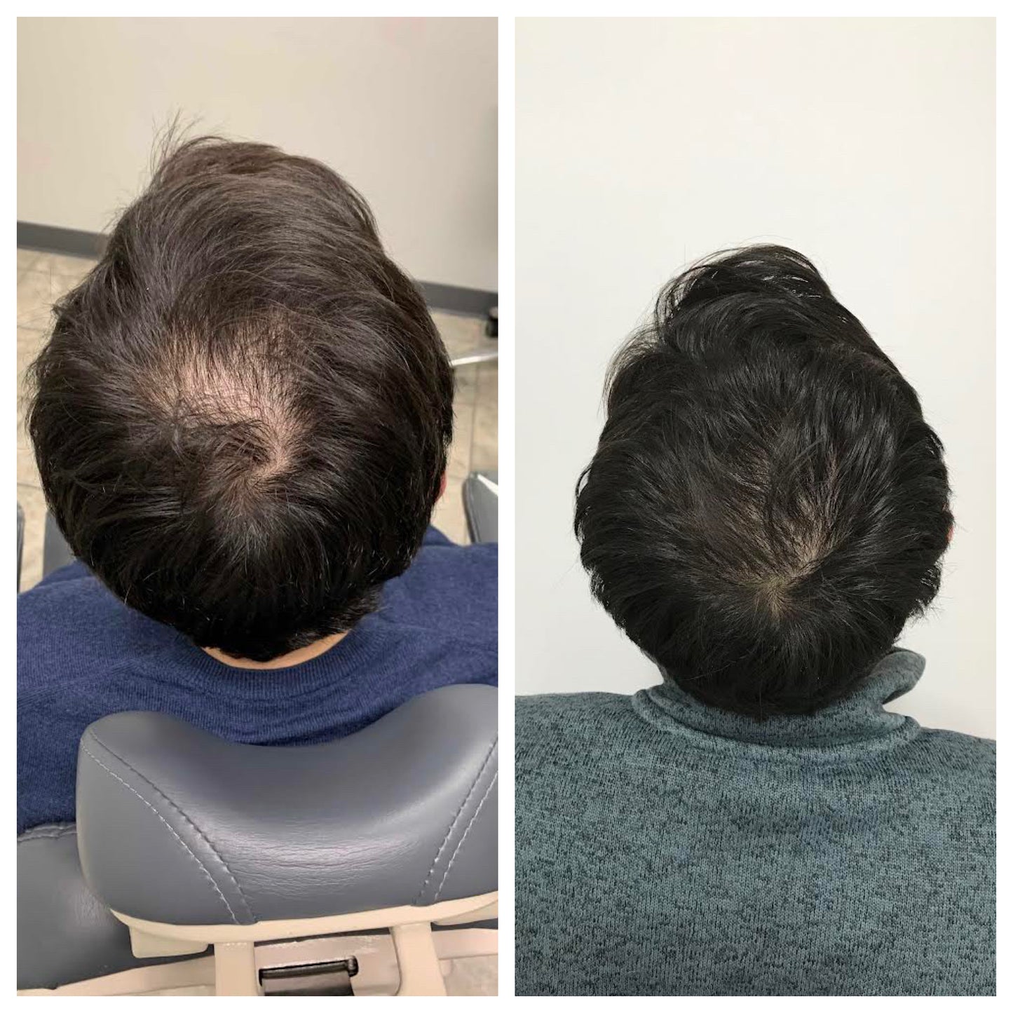 FEG Plus 👉( Men & women ) Hair Growth Spray ✅100% Original