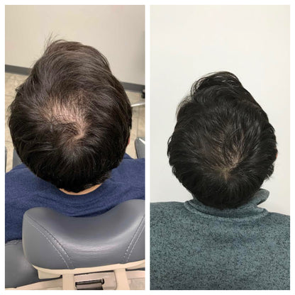 FEG Plus 👉( Men & women ) Hair Growth Spray ✅100% Original